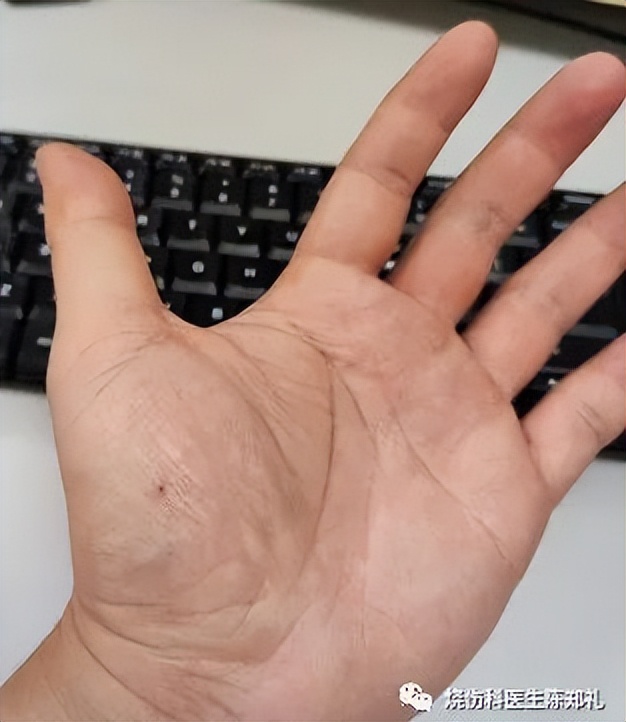 放烟花伤了人怎么办,鞭炮炸伤面部轻微怎么处理不留疤