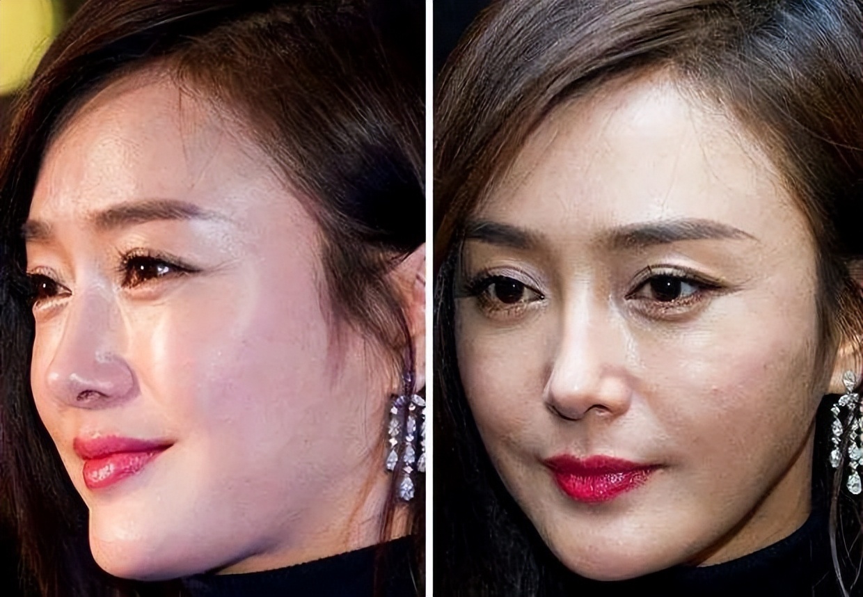 哪些明星整容后遗症越来越严重,整容明星后遗症对比图片