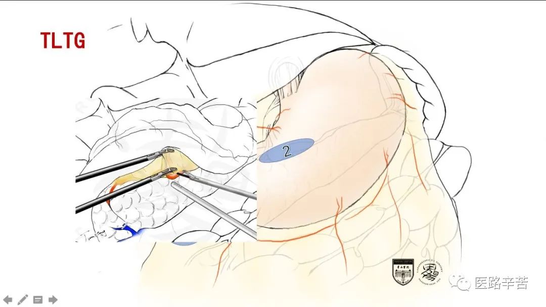 全腹腔镜胃癌根治术，学习大咖怎么清扫淋巴结