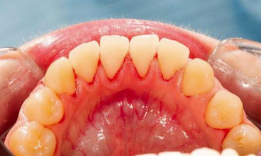 鐗欓緢鍑鸿瀹规槗寰椾粈涔堢梾,鐗欓緢鍑鸿瑕佽鎯曚粈涔堢梾