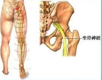 坐骨神经痛的恢复训练正确方法,坐骨神经痛可试试这7个小动作