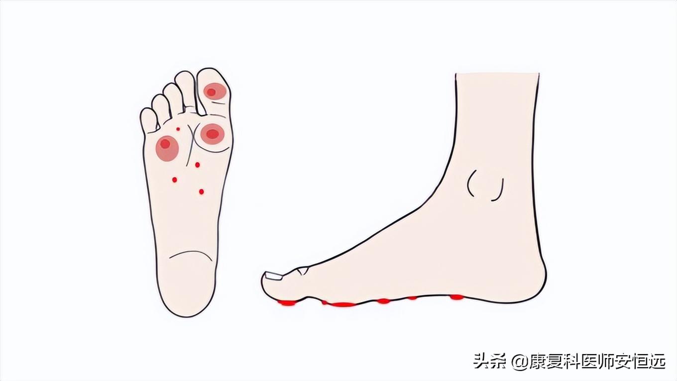 脚底板爱发烫是什么原因,脚底板生茧很疼怎么回事