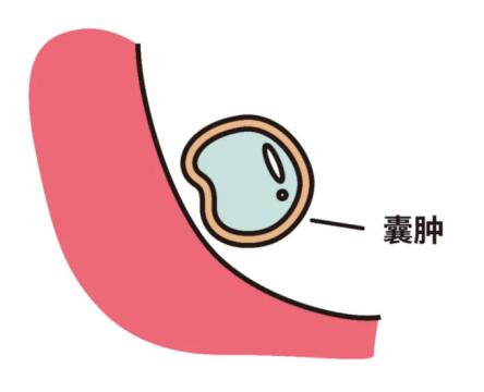 乳腺囊肿一定会癌变吗,乳腺囊肿会引起癌变吗