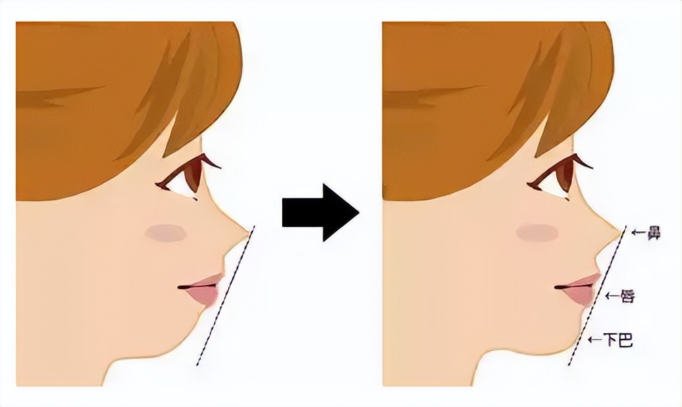 上海九院韦敏隆鼻,九院韦敏技术怎么样