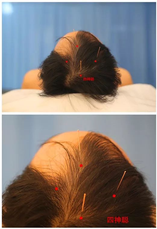 镇静安神的穴位推拿,镇静安神的方剂