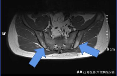 骶髂关节有必要做磁共振吗,患者担心花钱看不好病怎么回答