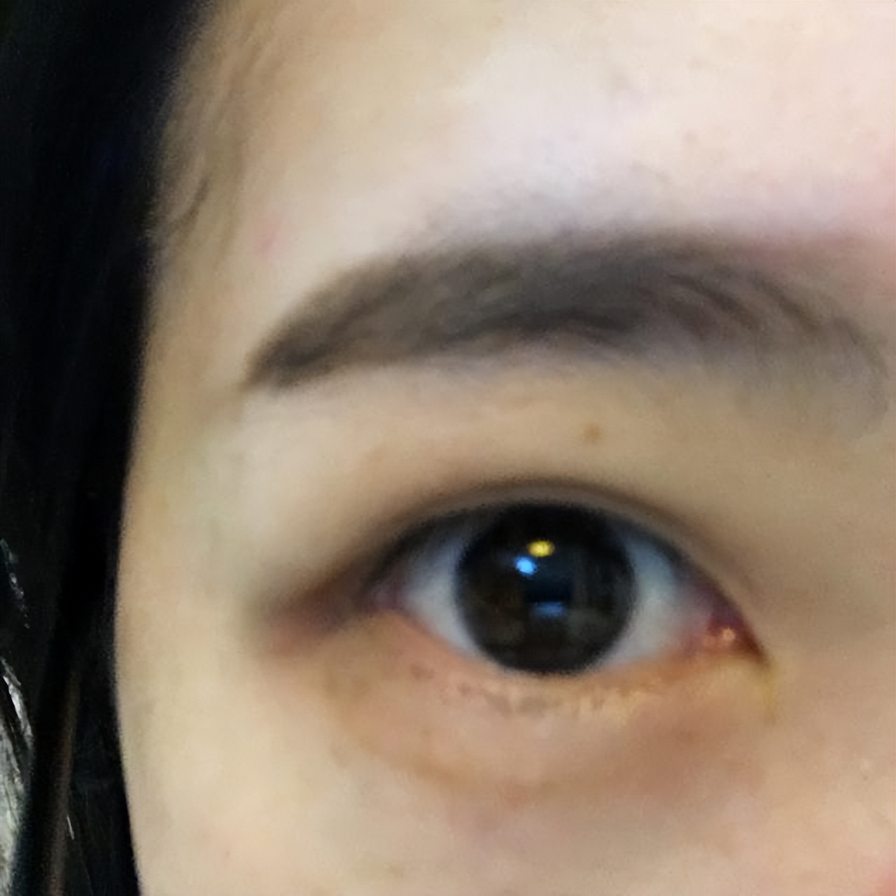 双眼皮手术后1-3天最尴尬的事,全切双眼皮出现大小眼是什么原因