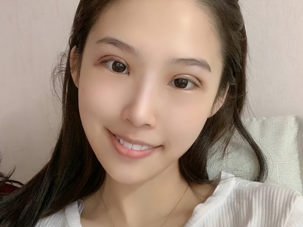 双眼皮手术前后干货,眼皮凹陷割双眼皮十个有九个后悔