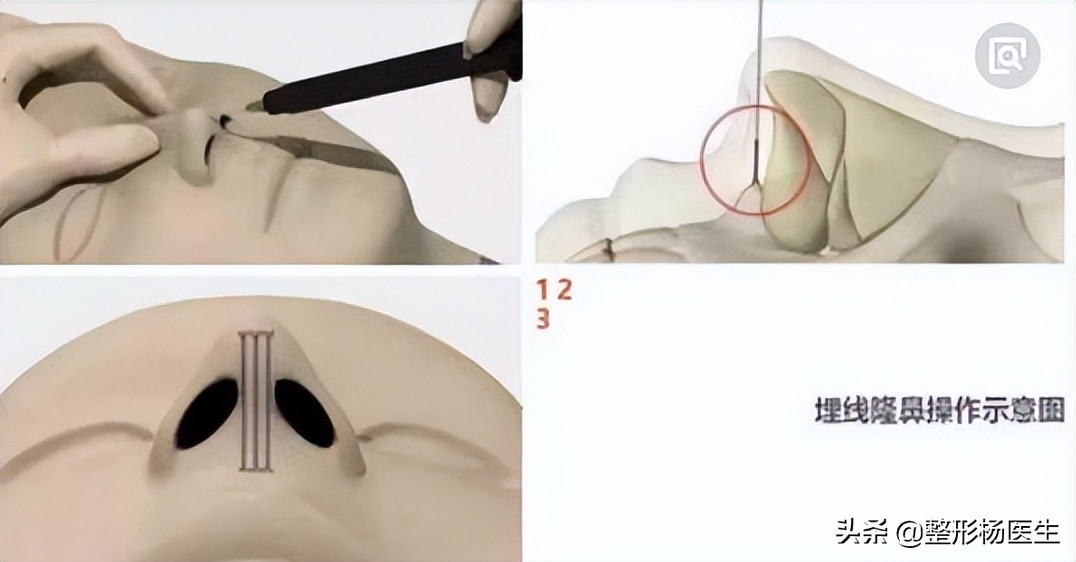 注射隆鼻和假体隆鼻哪个好,隆鼻和综合隆鼻整形有什么区别