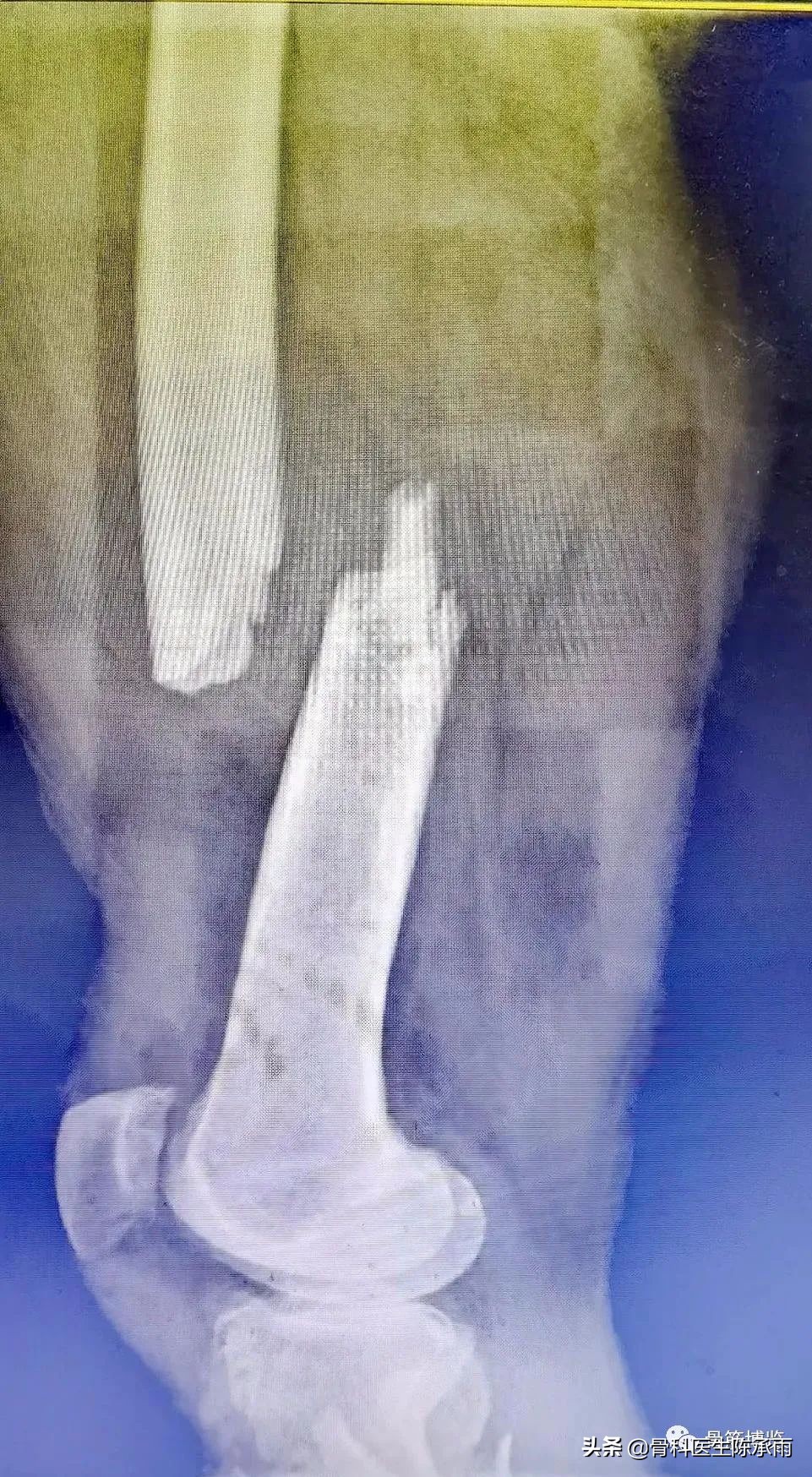 陈旧性腿骨骨折,陈旧性骨折