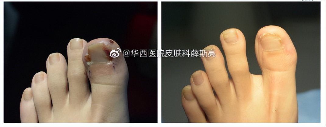 华西专家说，不是转你们，起码有一半的人从没有剪对过指甲儿！