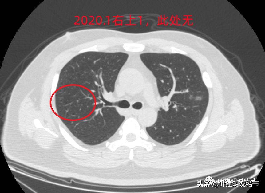 如何判断肺磨玻璃结节是高危结节,肺上有混合磨玻璃结节要注意什么