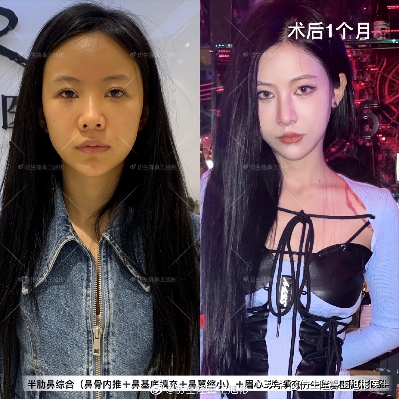 做一次鼻头缩小要多少钱好,可以只做鼻头缩鼻翼吗