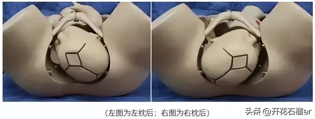 仰头和低头出生的区别,婴儿仰头出生和侧身出生