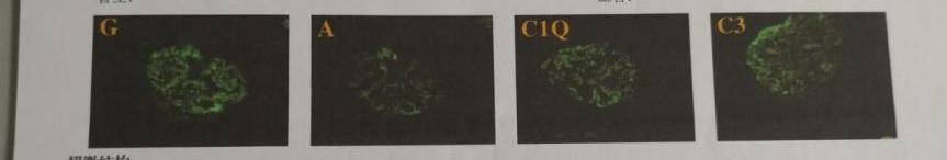 膜性肾病严重时患者会怎样,膜性肾病进展风险