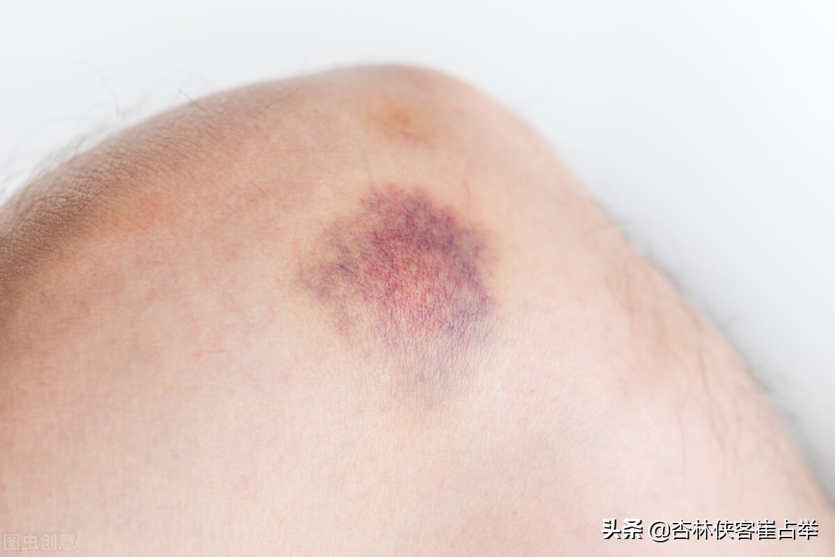 专治囊肿的药小金丸,囊肿吃小金丸可以散结吗