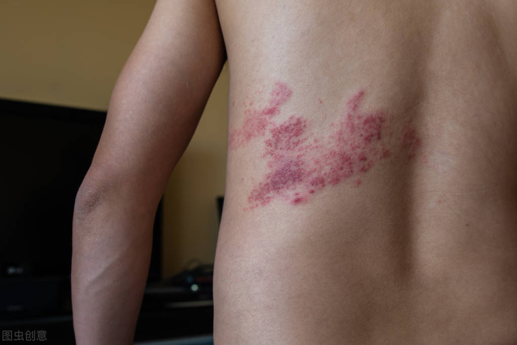 带状疱疹的水泡变大是痊愈征兆吗,带状疱疹长出水泡是不是快好了