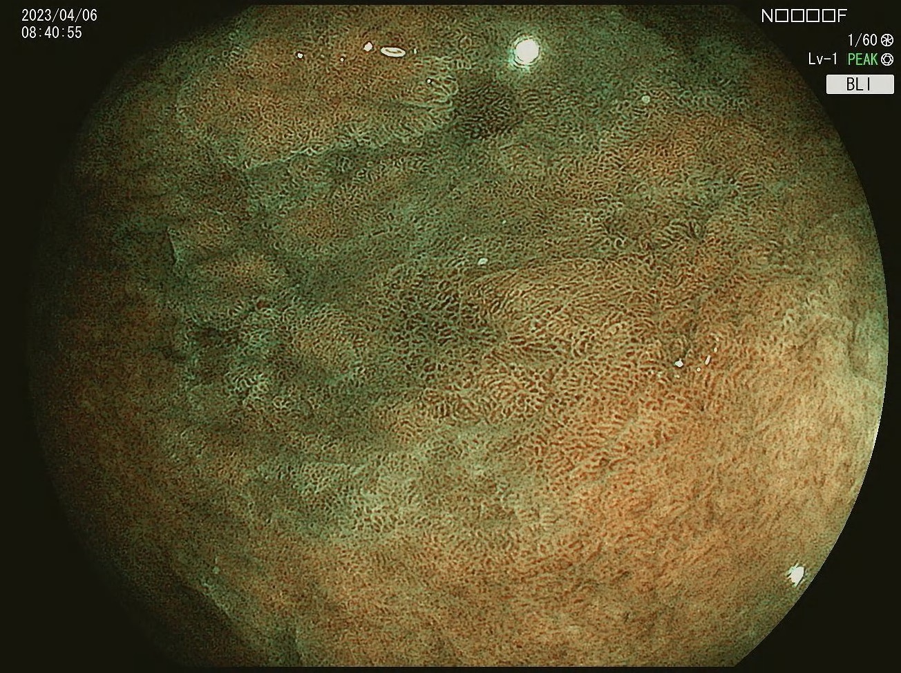 胃肠化的病人,胃肠化问题大吗