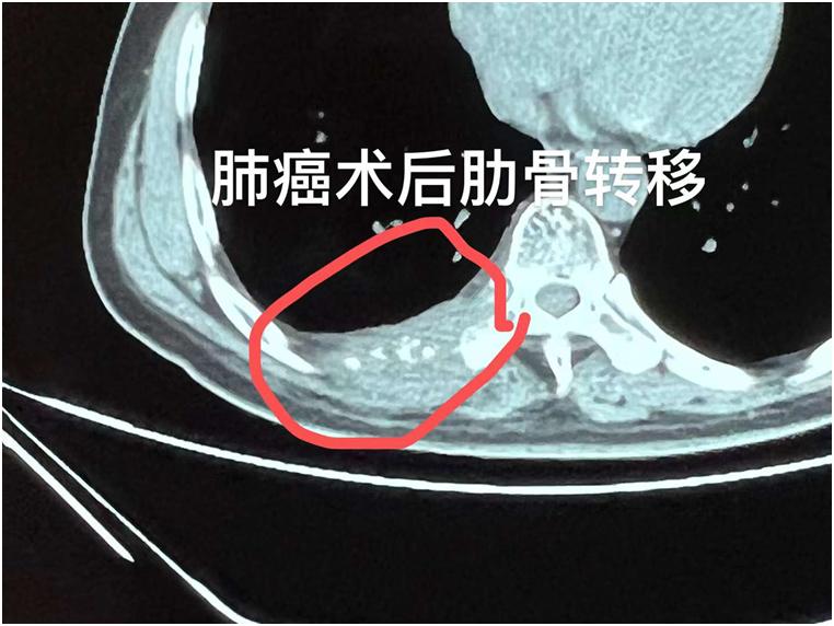 癌疼痛难忍,癌痛受不了热敷好多了
