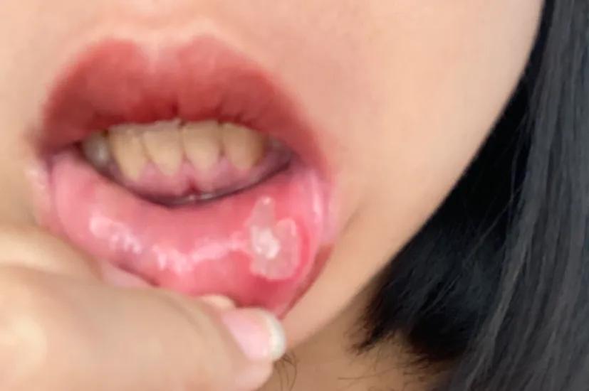 吃完海鲜全身痛,吃完海鲜后腹痛死亡