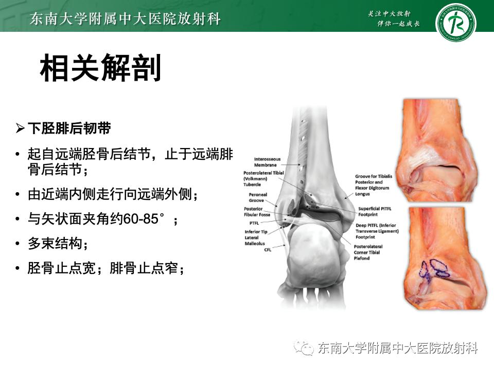 左腓骨下段骨折伴下胫腓联合分离,好文分享深度揭秘