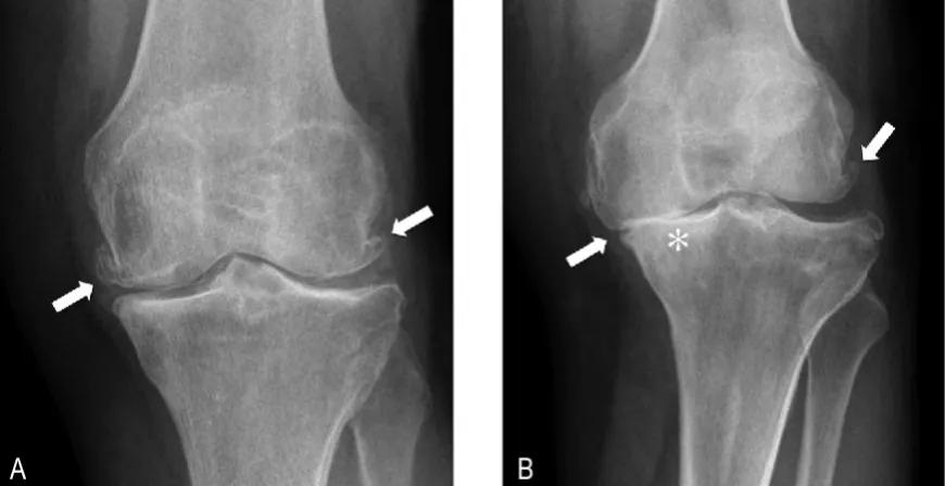氨糖软骨素到底有没有用,氨糖用多了