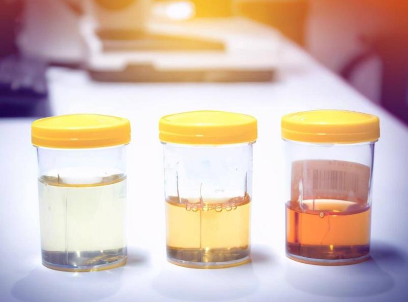 小便时泡沫多，除了肾不好，还可能与这3个原因有关，需了解