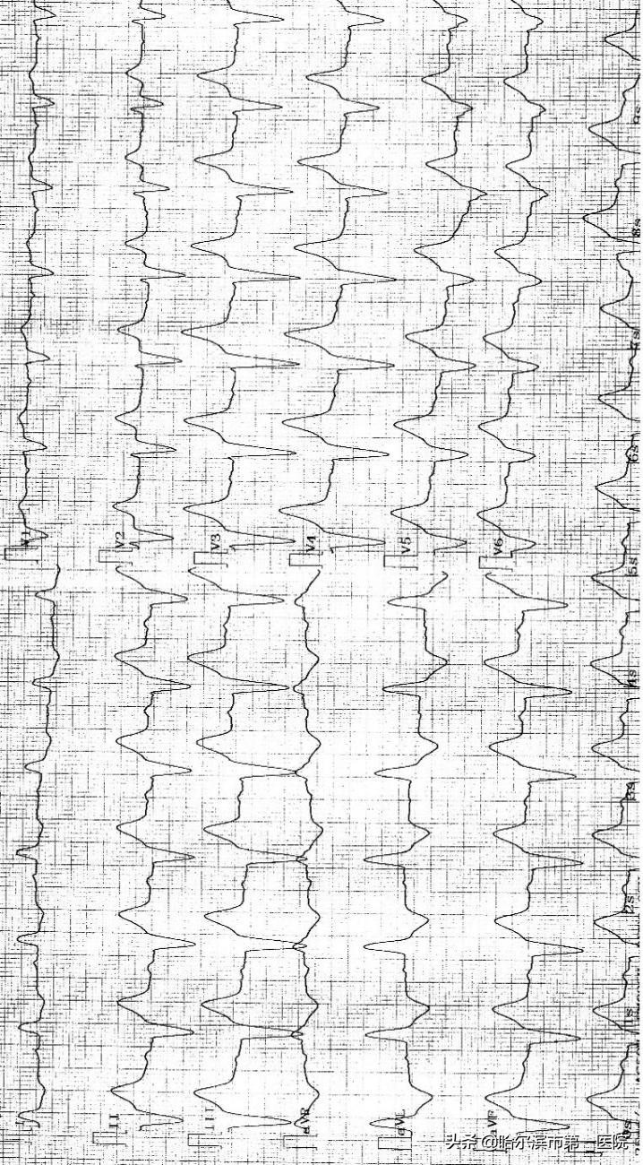哈尔滨市第一医院心律失常起搏治疗开启新时代为高龄老人植入“抗核磁全自动超大电池容量”心脏双腔起搏器