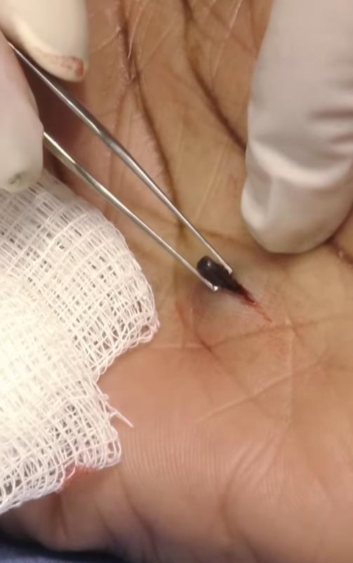 美国女子被橡皮子弹击中,女子手术取出戳20年铅笔芯