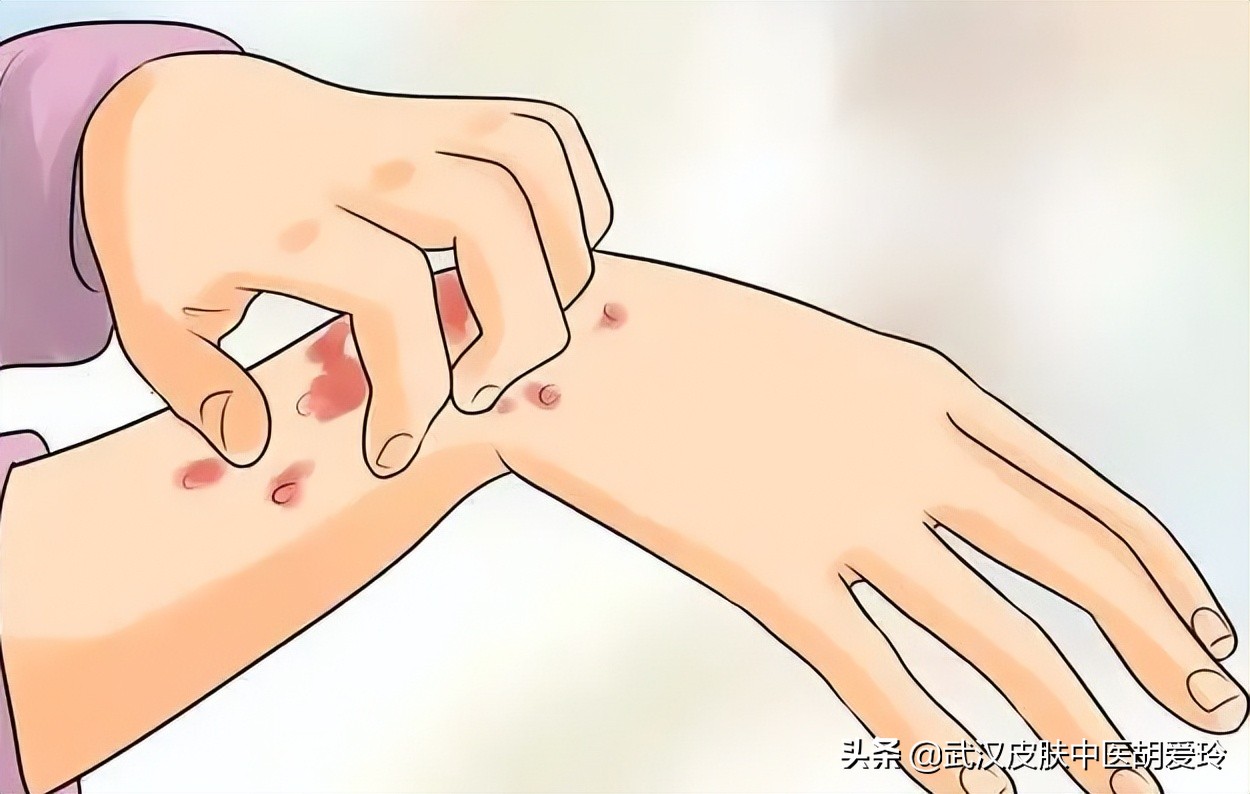 手痒起小水泡越挠越痒用什么药,小腿痒越挠越痒有红疹用什么药