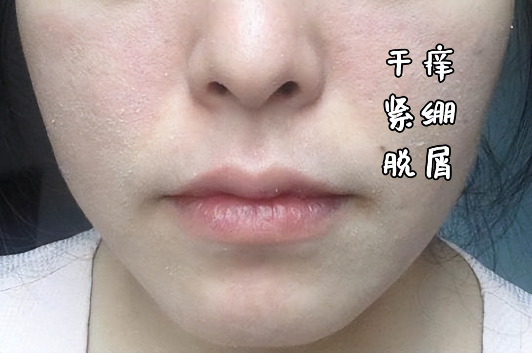 秋季干燥脱皮怎么办,秋季皮肤干燥起皮怎么解决