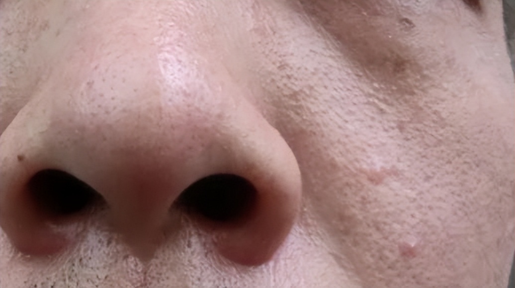 脸上起皮了是怎么回事,脸上起皮是什么原因怎么办