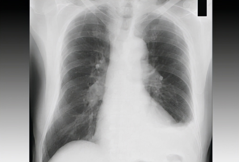 故事:非洲22岁小伙吃沙子上瘾,一天要吃五斤,身体发生怎样改变