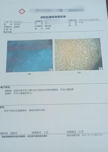 脚掌心水泡型足癣特别痒怎么办,脚趾发痒脱皮中医怎么诊断