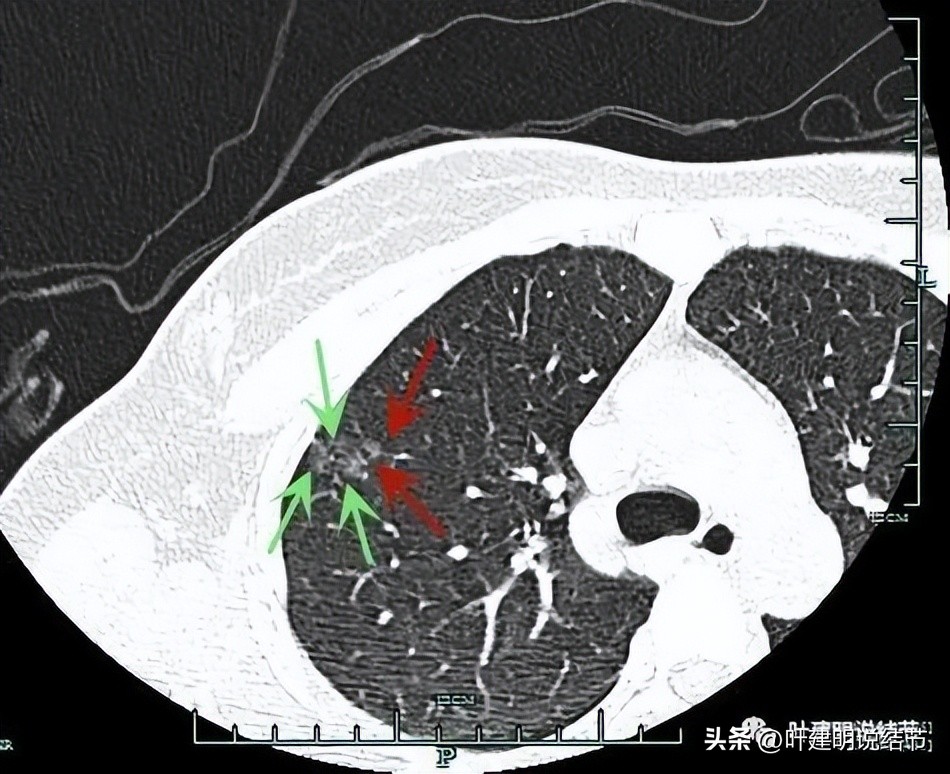 磨玻璃结节伴有增生是癌症吗,磨玻璃结节会是别的癌转移的吗