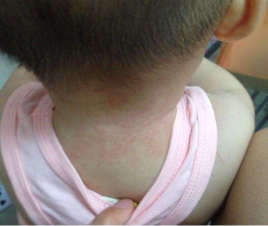 宝宝脖子痱子快速消退方法炉甘石,宝宝脖子起痱子可以保湿吗