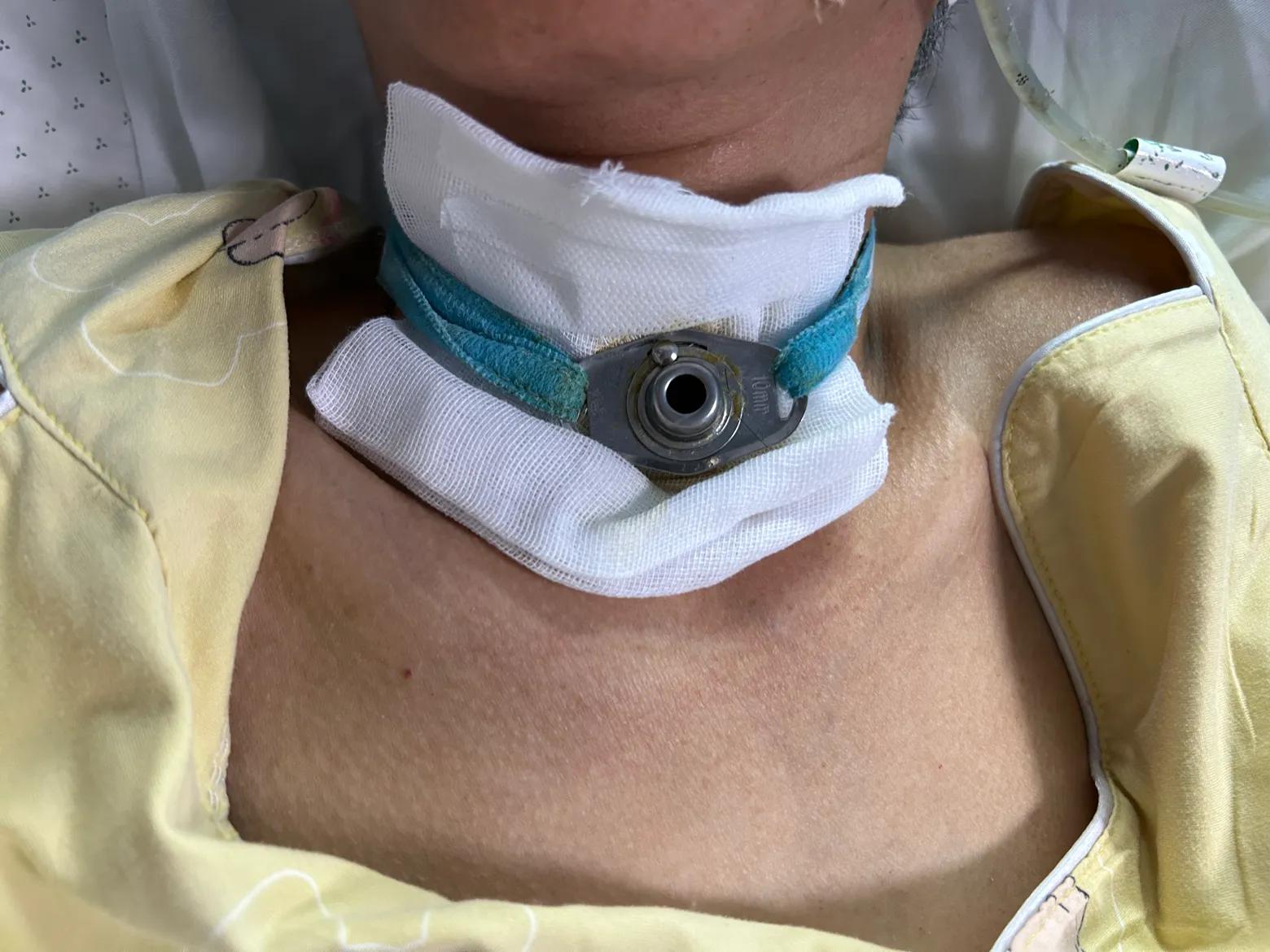 气管套管什么条件下可以拔除,怎么拔出气管套管