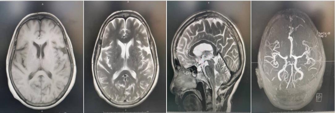 西安红会医院治疗癫痫怎么样,西安红会医院看帕金森