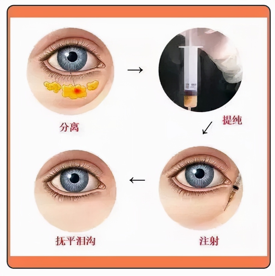 微整切眉去眼袋可以年轻多少岁,有几种快速去眼袋的方法