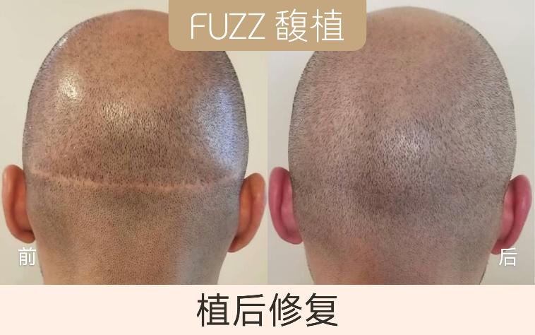 熬夜为什么脱发,熬夜脱发怎么办男生