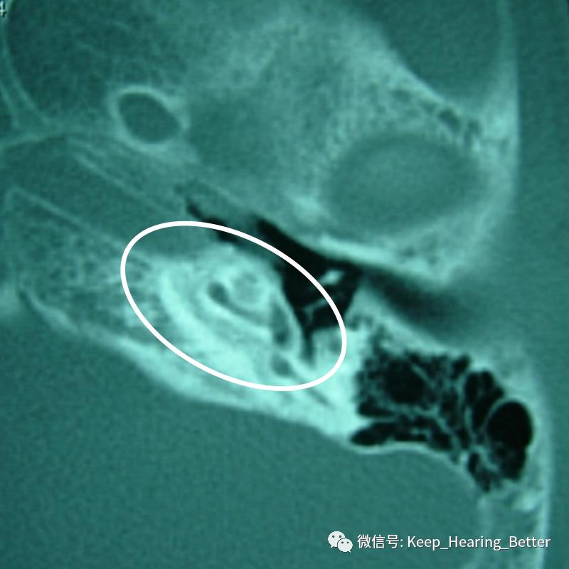 南昌大学二附院耳喉科,耳膜硬化症是什么样子