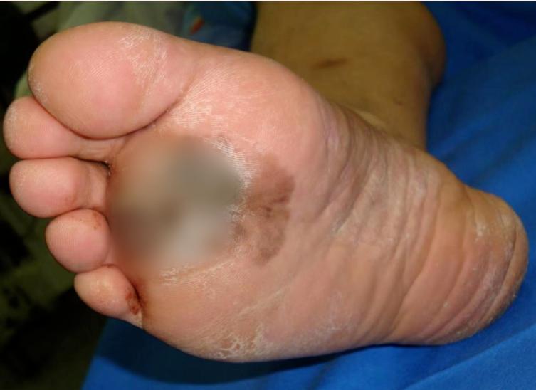 切除黑痣会不会引起癌变,黑痣受伤愈合后会不会恶变