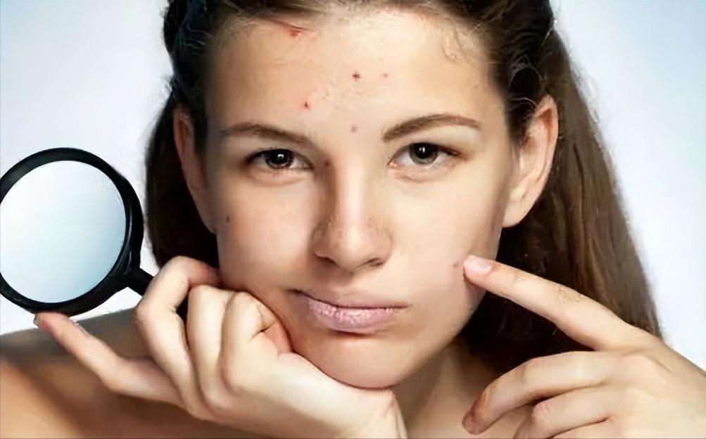 脸上长痘疮怎么去掉小妙招,脸上长痘疮的快速解决方法