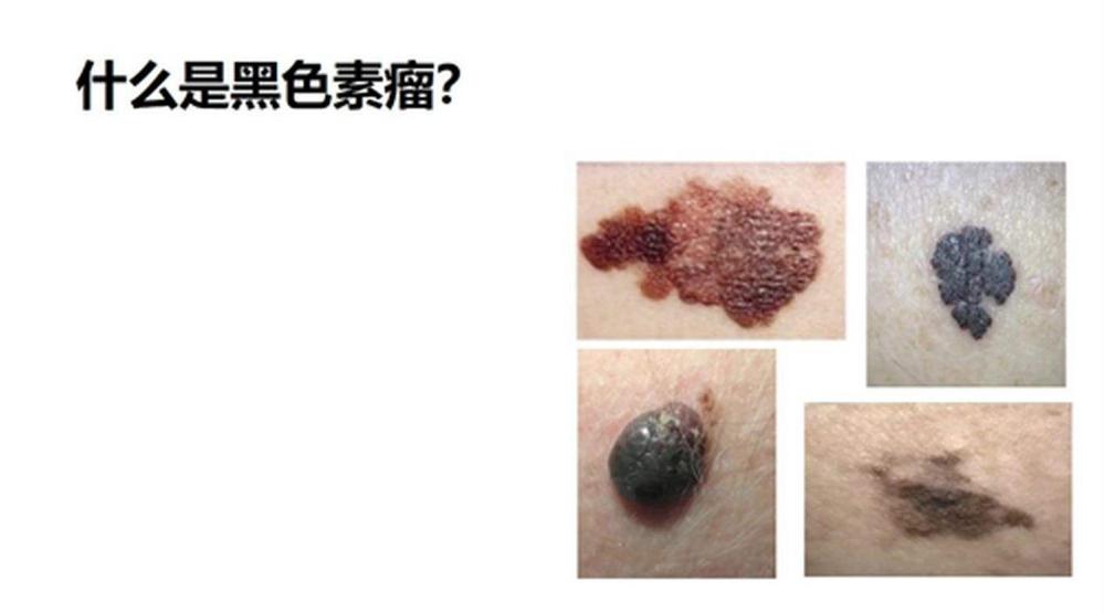 身上长这种颜色的痣要当心癌症,身上长痣怎么查是不是癌症