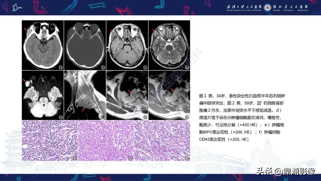 阴道肉瘤的早期症状,阴道里长肉瘤是啥症状
