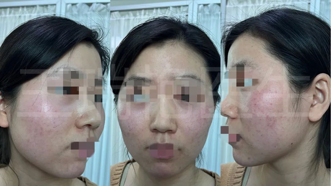 烂脸的警告,烂脸警告