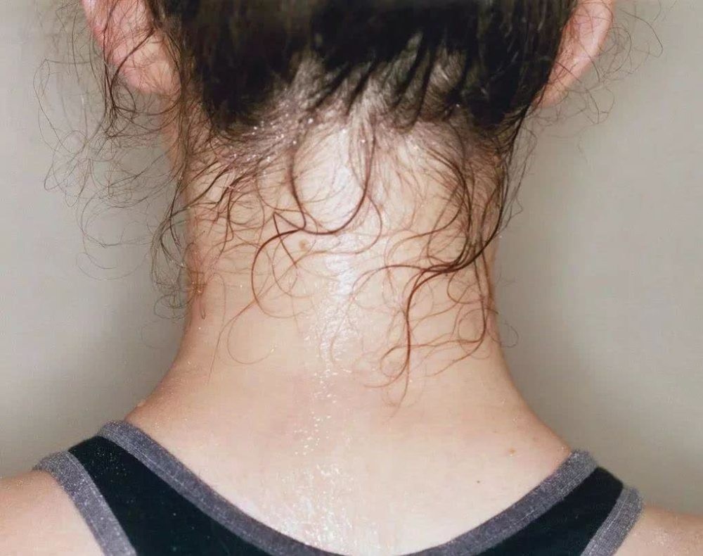 不同部位出汗暗示身体不同的问题,常出汗暗示4种疾病