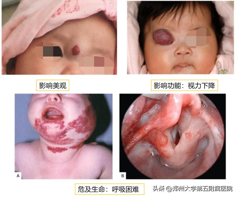 科普血管瘤有哪些治疗方法,海绵状血管瘤如何预防出血