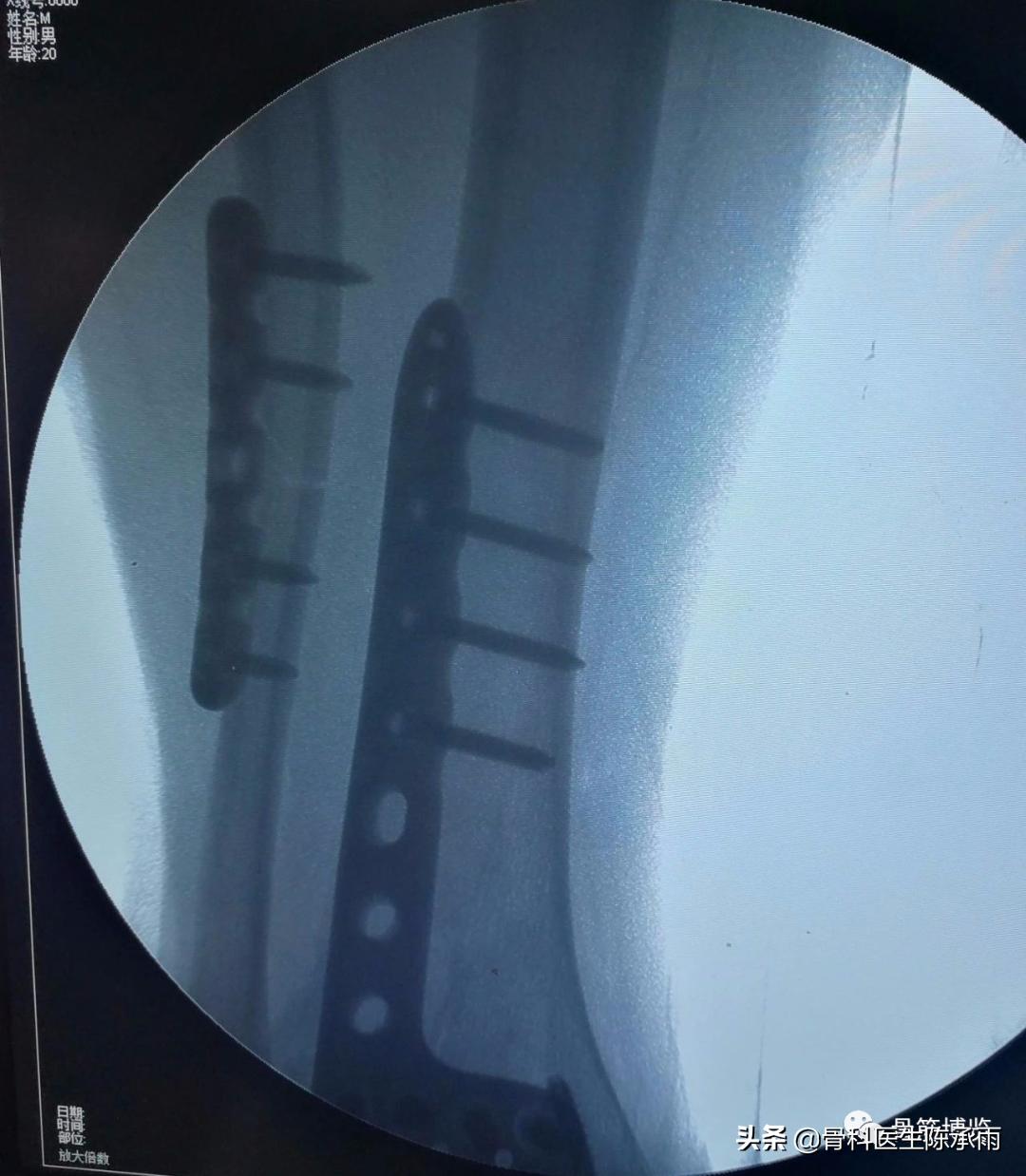 鑴氳笣楠ㄦ姌澶栧浐瀹氭敮鏋跺悗鎬庝箞鎭㈠,鑴氳笣楠ㄦ姌鐭宠啅鍜屽浐瀹氭敮鍏峰摢涓ソ