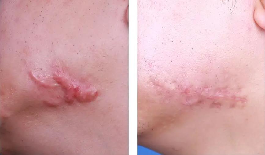 耳洞疤痕疙瘩反复复发怎么办,疤痕疙瘩治疗十几年后复发